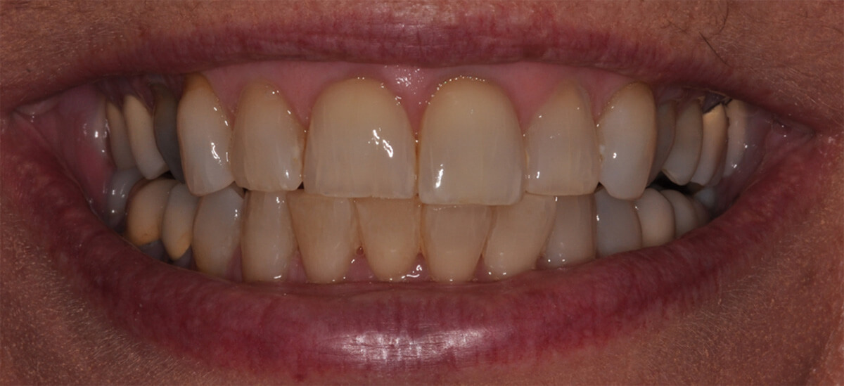 Smile Makeover Before Closeup