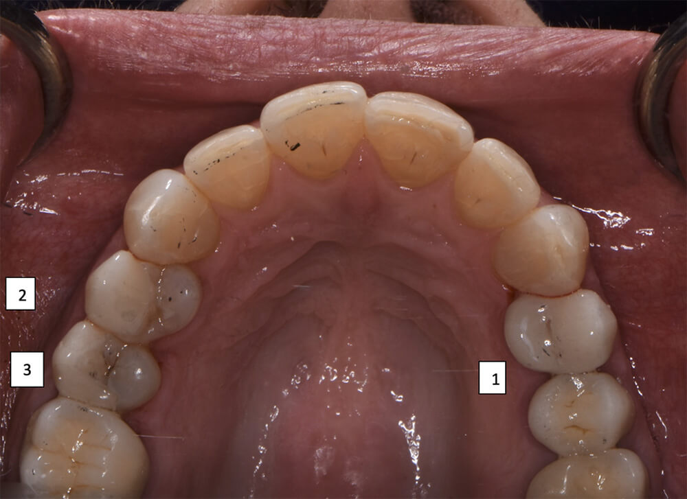 Smile Makeover - Partial Veneers